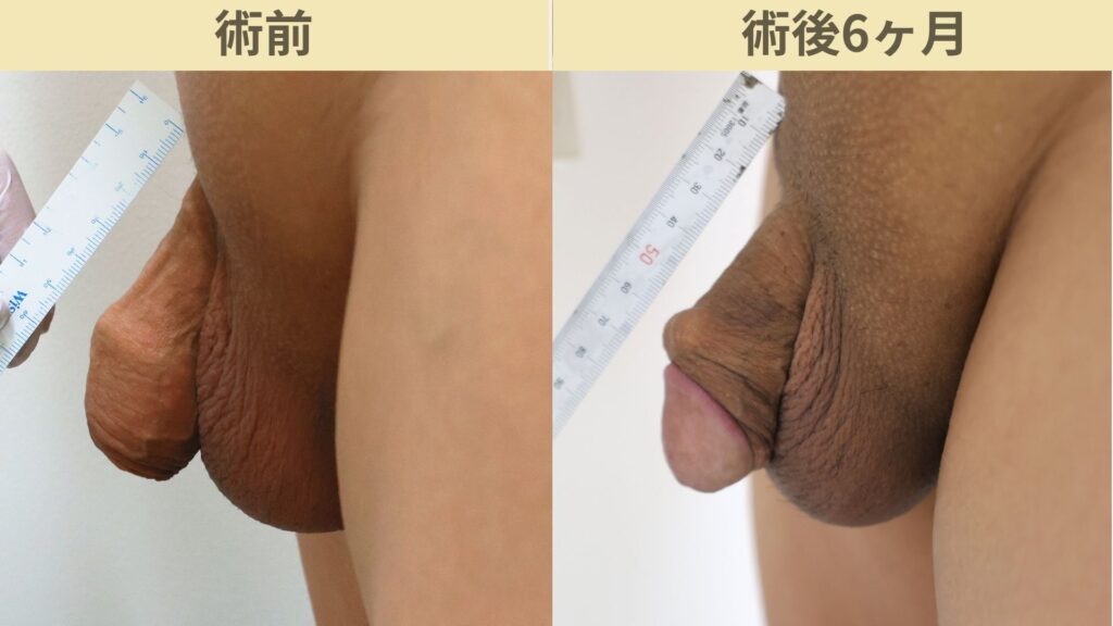 【症例54】40代男性 |アルモ式バック筋膜切開(靭帯剥離併用あり)+包茎術で長茎12mm延長術後6ヶ月2