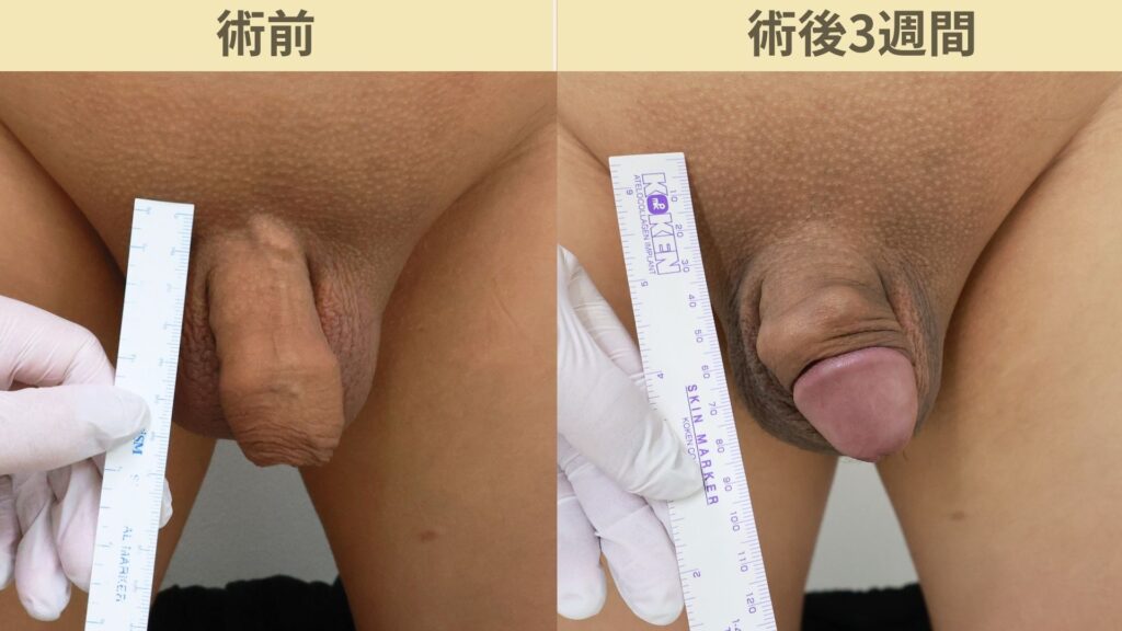 【症例54】40代男性 |アルモ式バック筋膜切開(靭帯剥離併用あり)+包茎術で長茎12mm延長術後3週間2