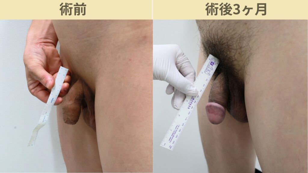 【症例58】30代男性 |アルモ式バック筋膜切開(靭帯剥離併用あり)+包茎術で長茎25mm延長術後3ヶ月2