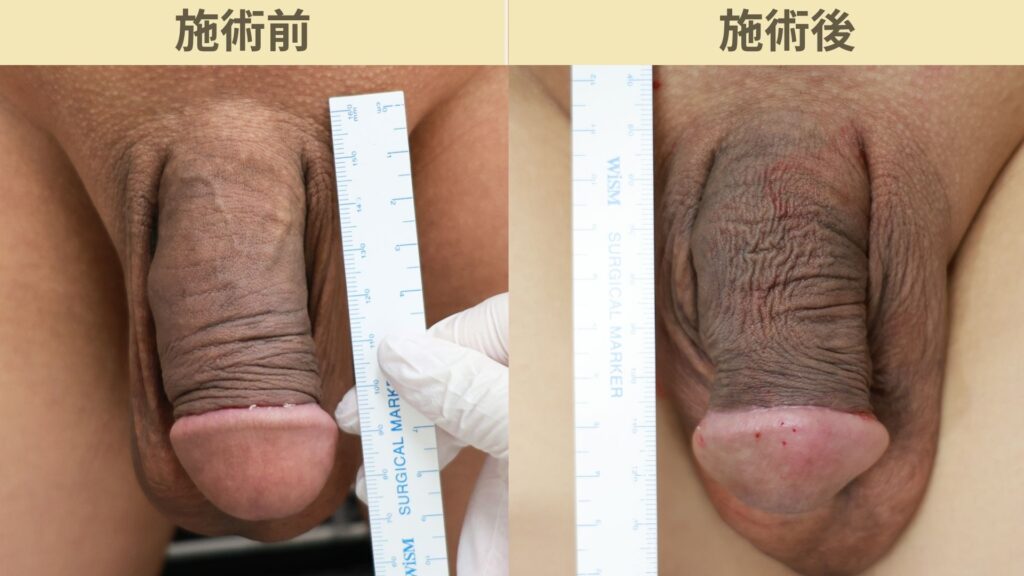 【症例73】30代男性 ｜亀頭ヒアルロン酸注入4ccで9ｍｍの増大症例施術後3週間