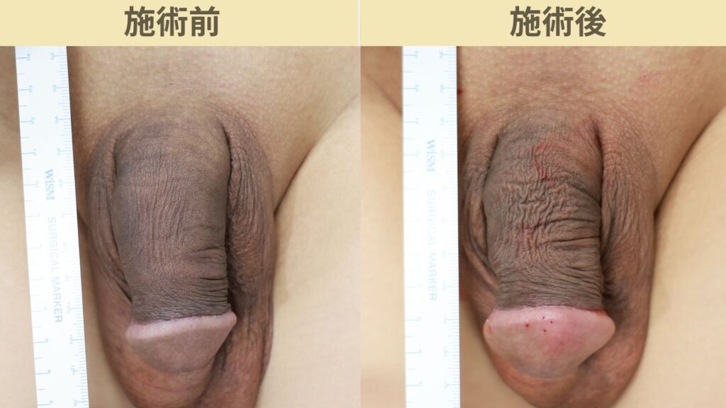 【症例73】30代男性 ｜亀頭ヒアルロン酸注入4ccで9ｍｍの増大症例施術後1ヶ月