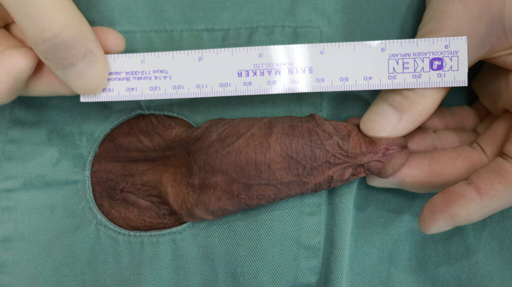 【症例74】30代男性 ｜カリ高増大術（電気分解法）で存在感あるカリ高を実現施術後