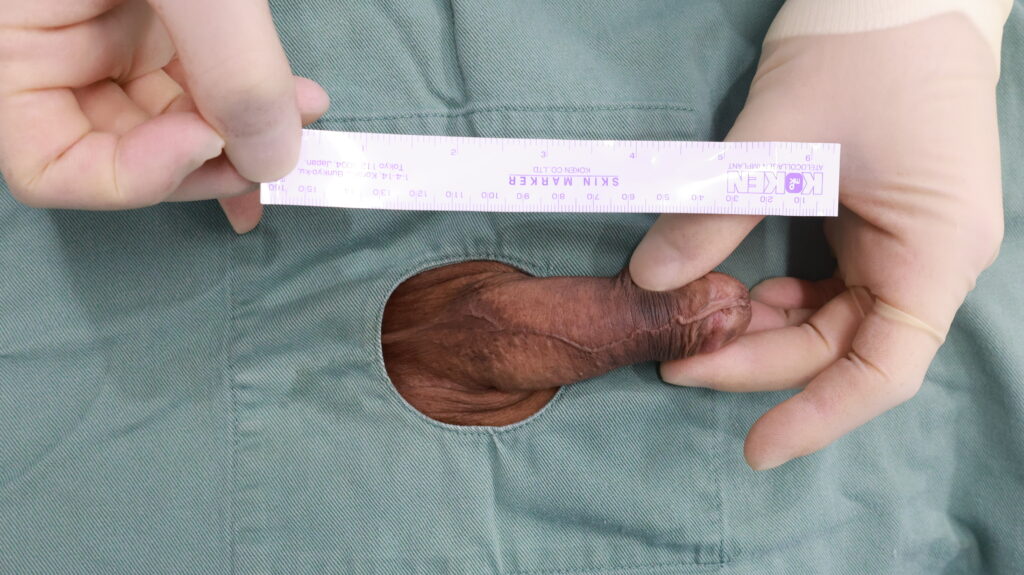 【症例59】50代男性 ｜アルモ式バック筋膜切開（靭帯剥離併用あり）＋包茎術で長茎18mm延長術前2