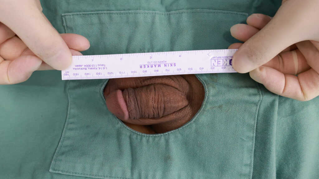 【症例60】30代男性 ｜アルモ式バック筋膜切開（靭帯剥離併用あり）＋包茎術で陰茎16mm増大術前