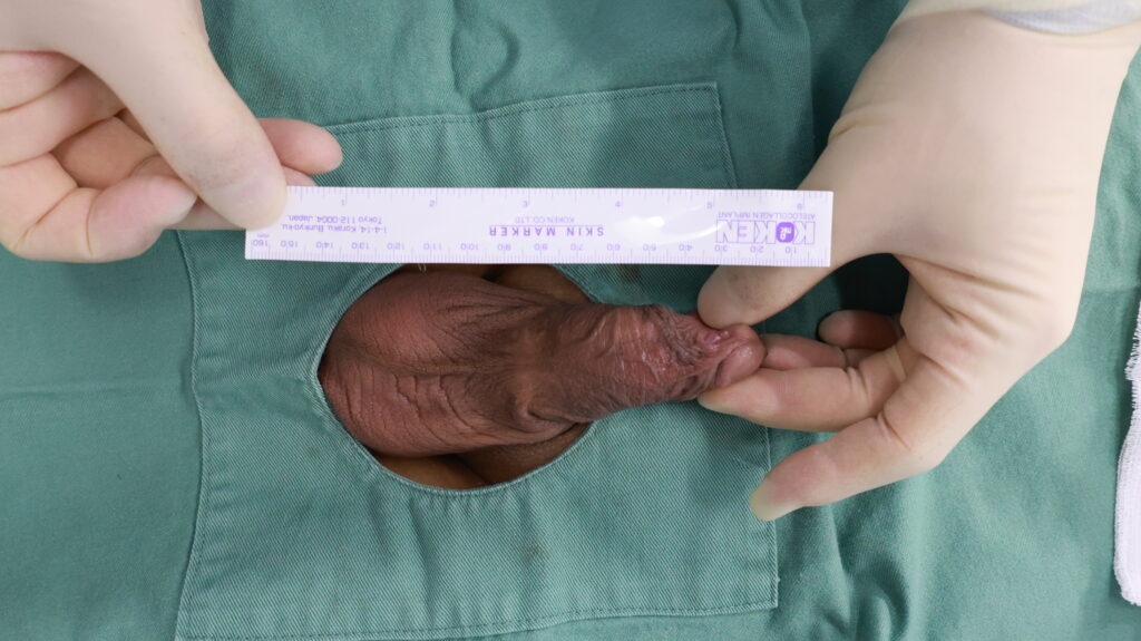 【症例60】30代男性 ｜アルモ式バック筋膜切開（靭帯剥離併用あり）＋包茎術で陰茎16mm増大術前2
