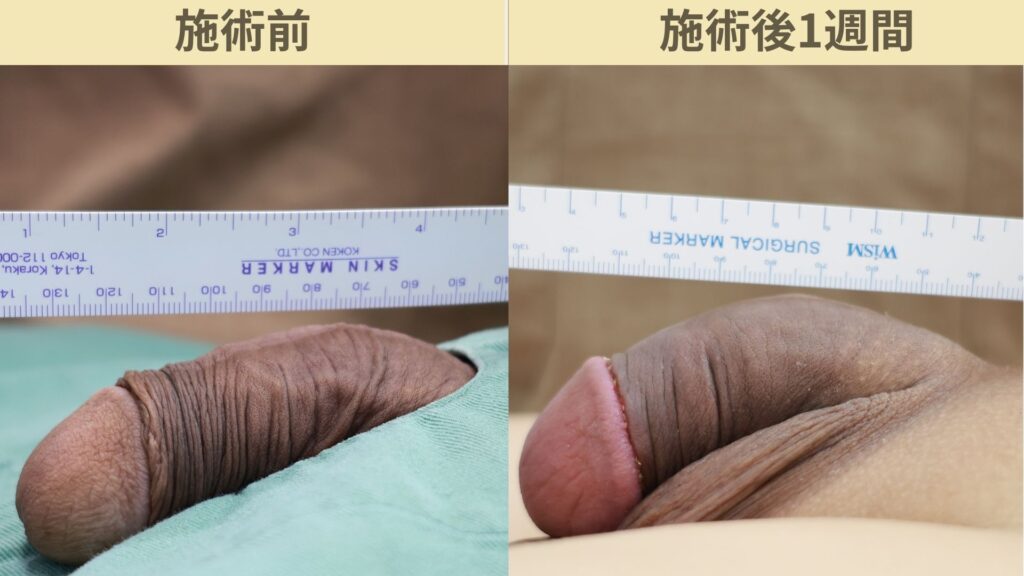 【症例74】30代男性 ｜カリ高増大術（電気分解法）で存在感あるカリ高を実現施術後1週間