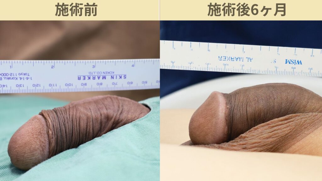 【症例74】30代男性 ｜カリ高増大術（電気分解法）で存在感あるカリ高を実現施術後6ヶ月