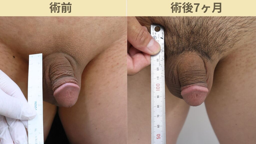 【症例60】30代男性 ｜アルモ式バック筋膜切開（靭帯剥離併用あり）＋包茎術で陰茎16mm増大術後7ヶ月