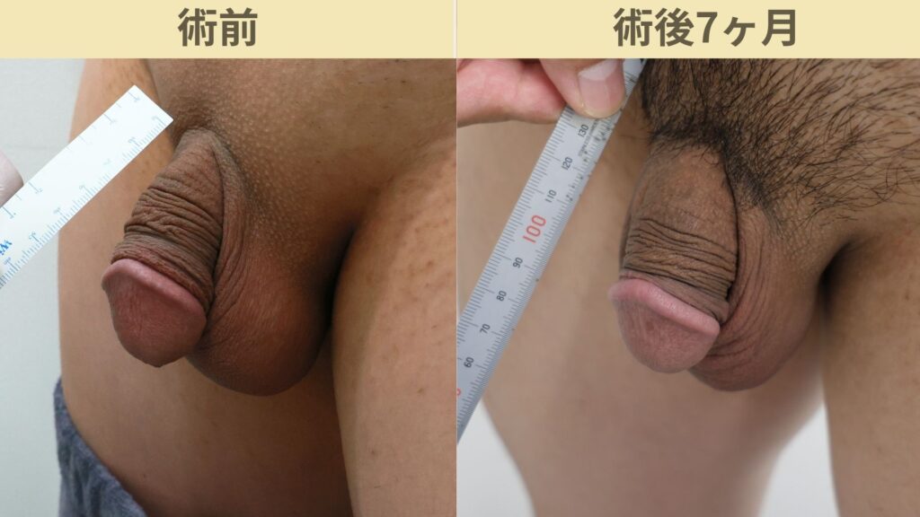 【症例60】30代男性 ｜アルモ式バック筋膜切開（靭帯剥離併用あり）＋包茎術で陰茎16mm増大術後7ヶ月2