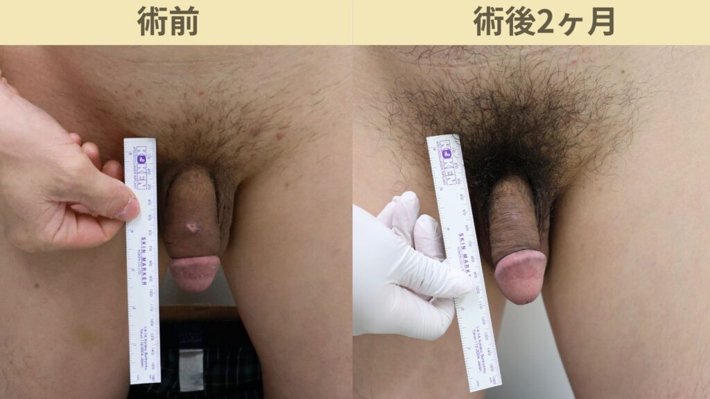 【症例71】30代男性 |亀頭ヒアルロン酸注入5ccで8mmの増大症例施術後2か月2