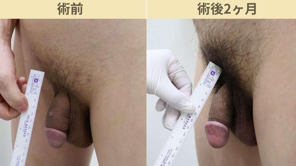 【症例71】30代男性 |亀頭ヒアルロン酸注入5ccで8mmの増大症例施術後2ヶ月3