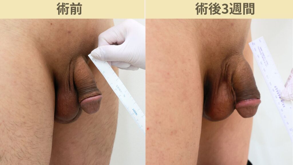【症例59】50代男性 ｜アルモ式バック筋膜切開（靭帯剥離併用あり）＋包茎術で長茎18mm延長術後3週間3