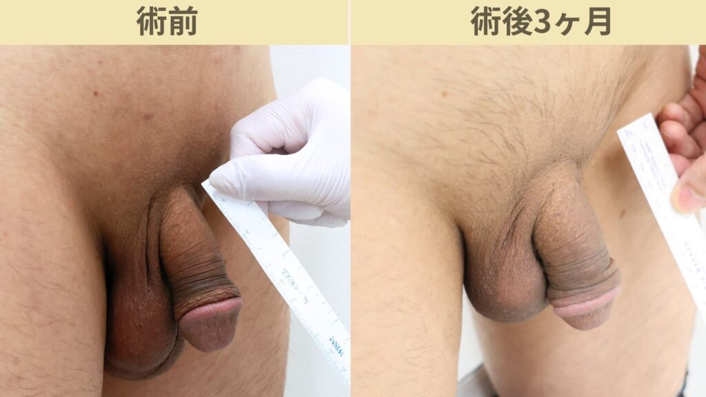 【症例59】50代男性 ｜アルモ式バック筋膜切開（靭帯剥離併用あり）＋包茎術で長茎18mm延長術後3ヶ月