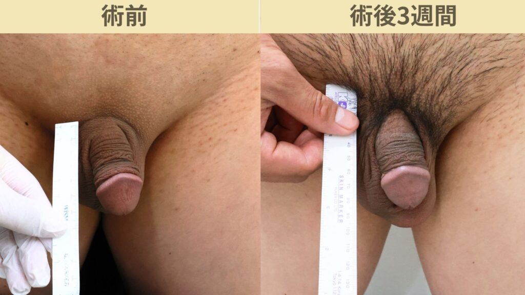 【症例60】30代男性 ｜アルモ式バック筋膜切開（靭帯剥離併用あり）＋包茎術で陰茎16mm増大術後3週間