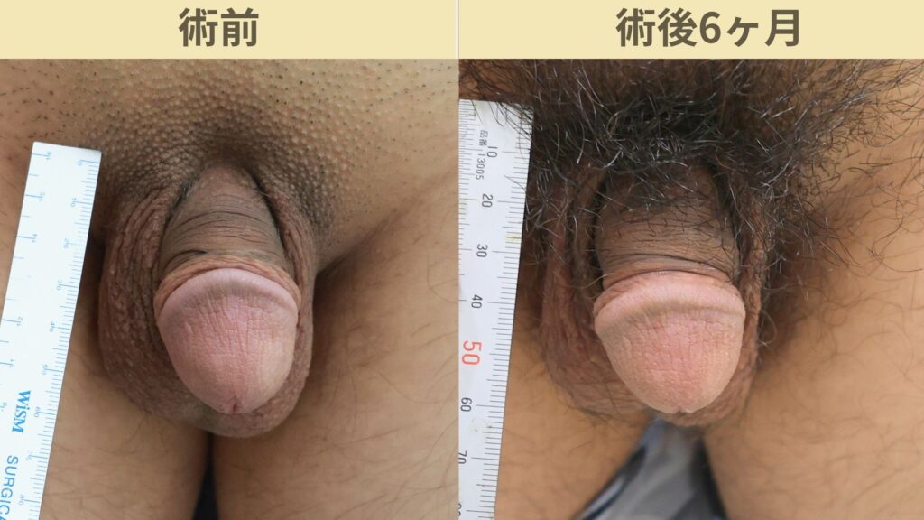 【症例53】20代男性 ｜アルモ式バック筋膜切開（靭帯剥離併用あり）＋包皮切除で11ｍｍ延長術後6ヶ月