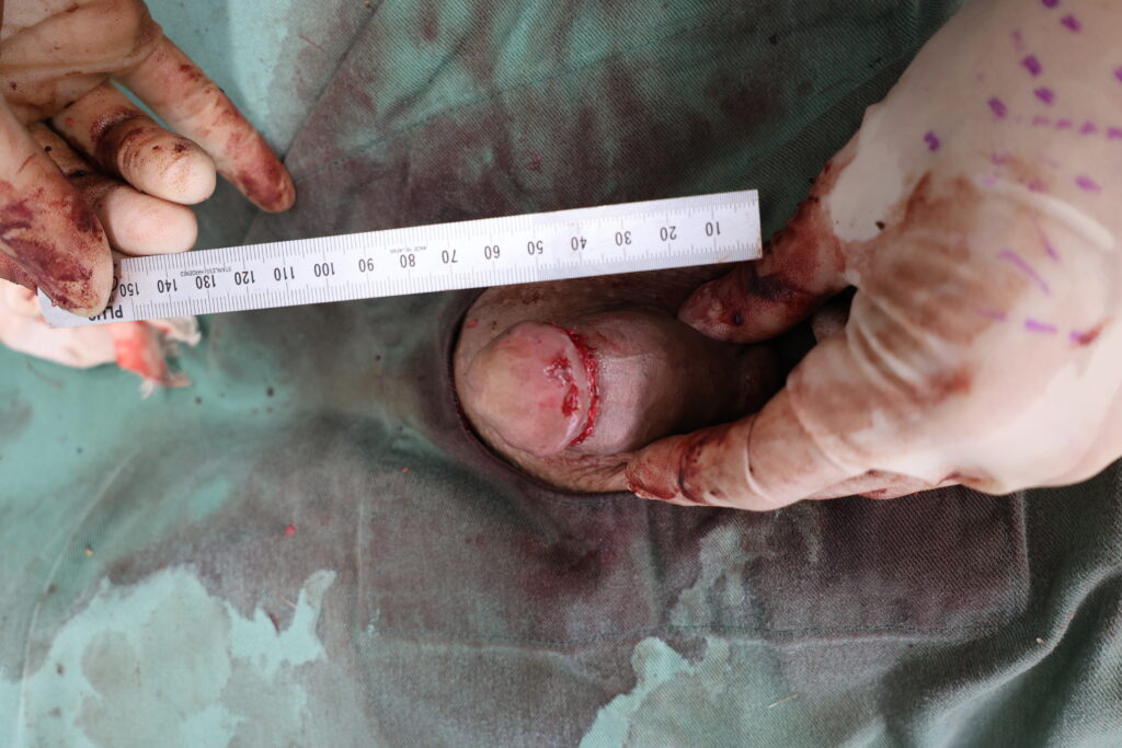 【症例83】30代男性 ｜真皮脂肪移植による亀頭増大で8ｍｍ増大術後2