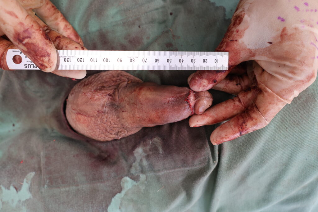 【症例82】30代男性 ｜リパス除去と同時に陰茎増大術により15mm延長術後3