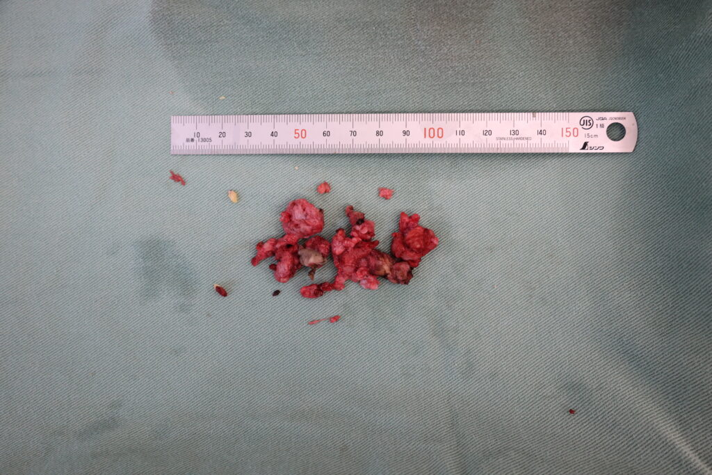 【症例82】30代男性 ｜リパス除去と同時に陰茎増大術により15mm延長術後