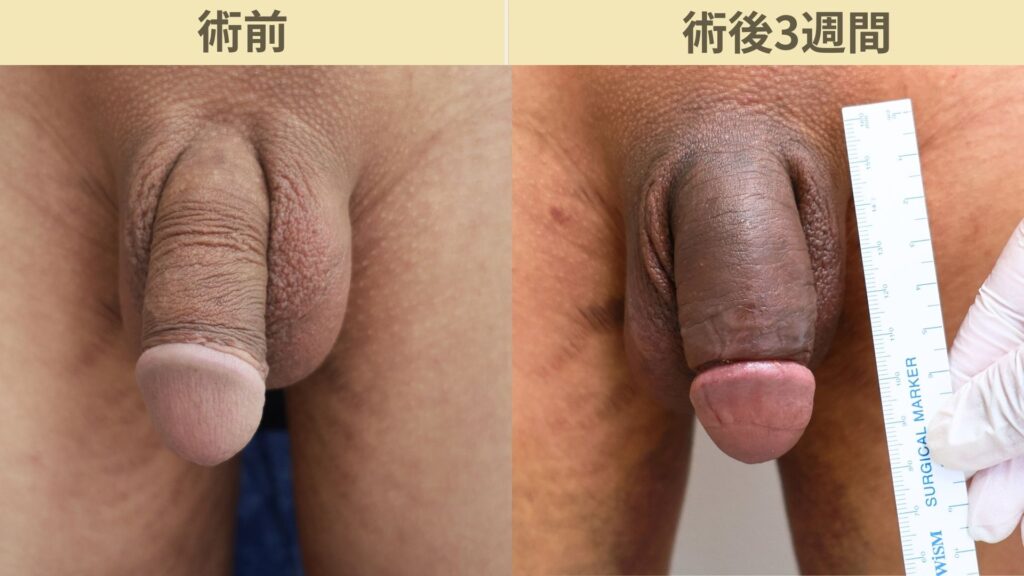 【症例36】20代男性 ｜アルモ式バック筋膜切開（靭帯剥離併用あり）＋他院修正で長茎23ｍｍ延長術後3週間3