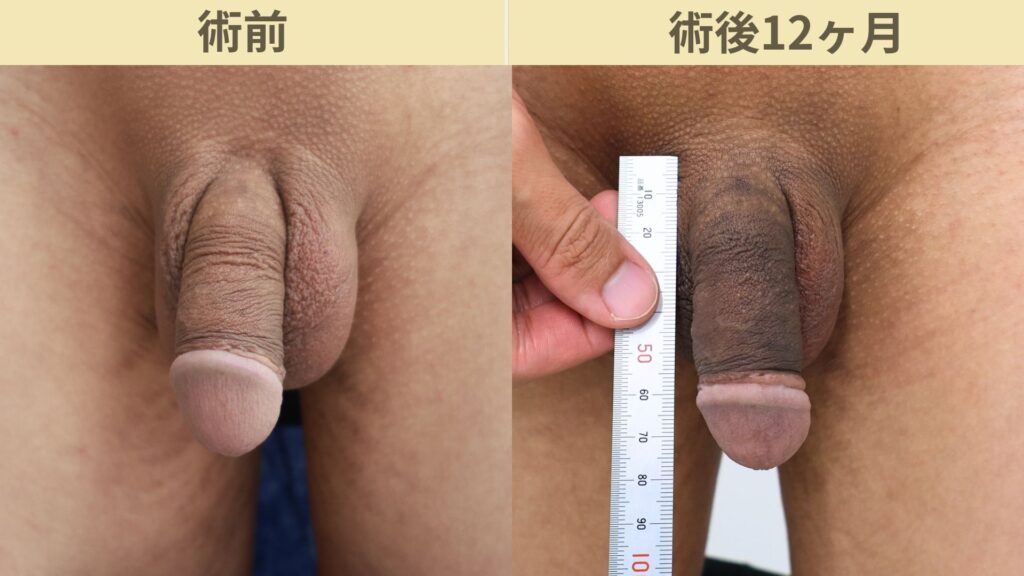 【症例36】20代男性 ｜アルモ式バック筋膜切開（靭帯剥離併用あり）＋他院修正で長茎23ｍｍ延長術後12ヶ月