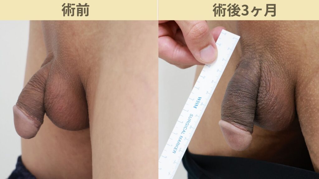 【症例36】20代男性 ｜アルモ式バック筋膜切開（靭帯剥離併用あり）＋他院修正で長茎23ｍｍ延長術後3ヶ月
