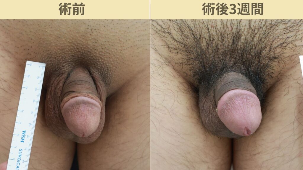 【症例53】20代男性 ｜アルモ式バック筋膜切開（靭帯剥離併用あり）＋包皮切除で11ｍｍ延長術後3週間3