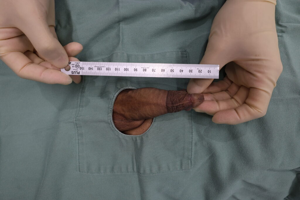 【症例70】40代男性 ｜アルモ式バック筋膜切開（靭帯剥離併用あり）＋包茎術で長茎21mm延長術前2