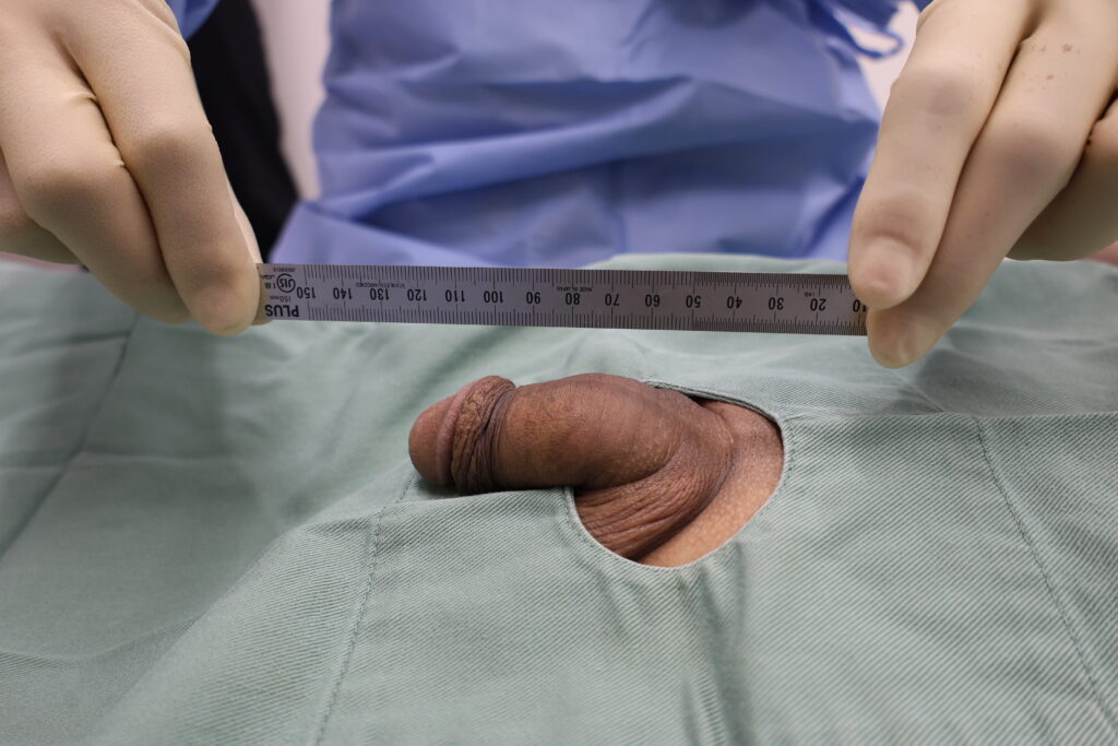 【症例70】40代男性 ｜アルモ式バック筋膜切開（靭帯剥離併用あり）＋包茎術で長茎21mm延長術前