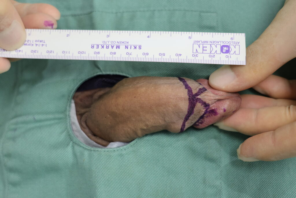 【症例19】40代男性 ｜アルモ式バック筋膜切開（靭帯剥離併用あり）で8ｍｍ増大術前2