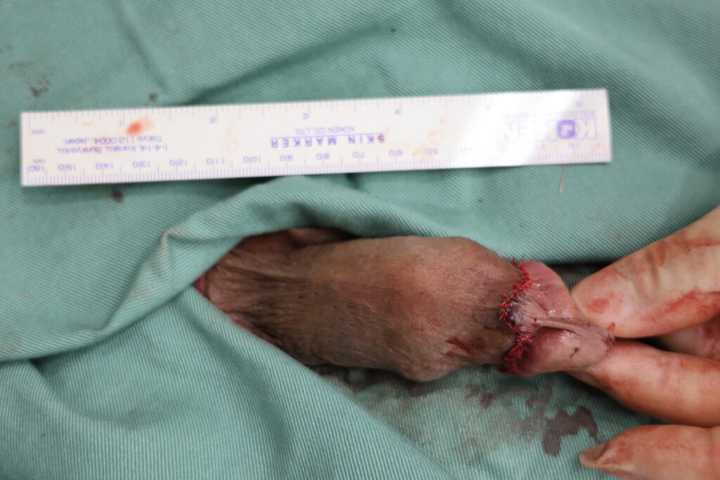 【症例19】40代男性 ｜アルモ式バック筋膜切開（靭帯剥離併用あり）で8ｍｍ増大術後2