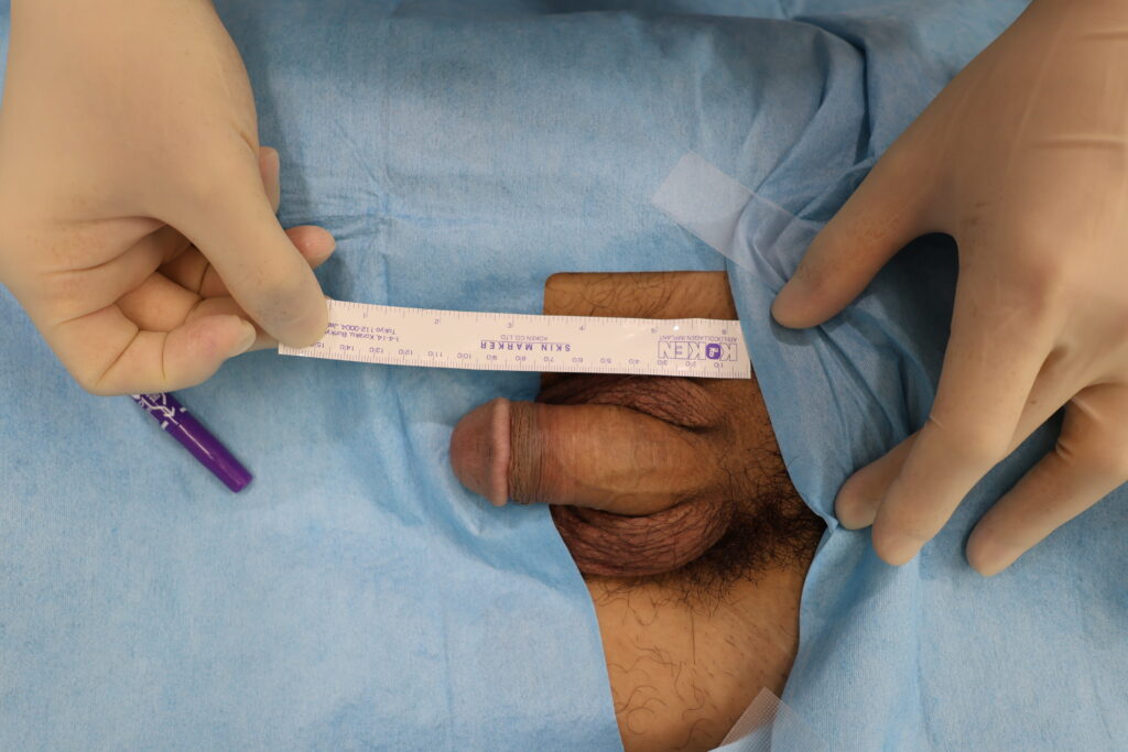 【症例20】30代男性 ｜アルモ式バック筋膜切開（靭帯剥離併用あり）＋包茎術で長茎19mm延長術前