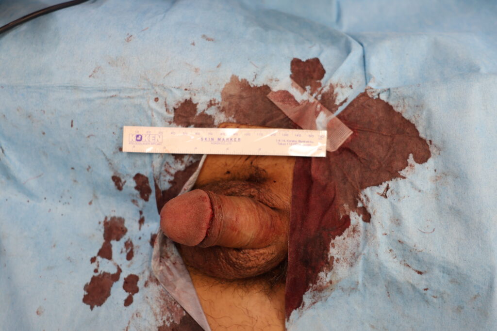 【症例84】30代男性 |真皮脂肪移植による亀頭増大で7mmの増大術後