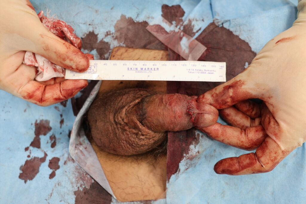 【症例20】30代男性 ｜アルモ式バック筋膜切開（靭帯剥離併用あり）＋包茎術で長茎19mm延長術後2