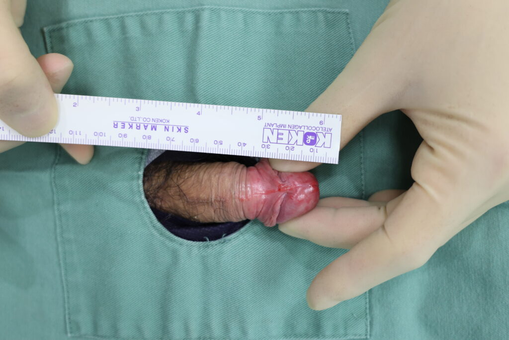 【症例23】40代男性 |アルモ式バック筋膜切開(靭帯剥離併用あり)+包茎術+小帯切開で16mm延長術前2