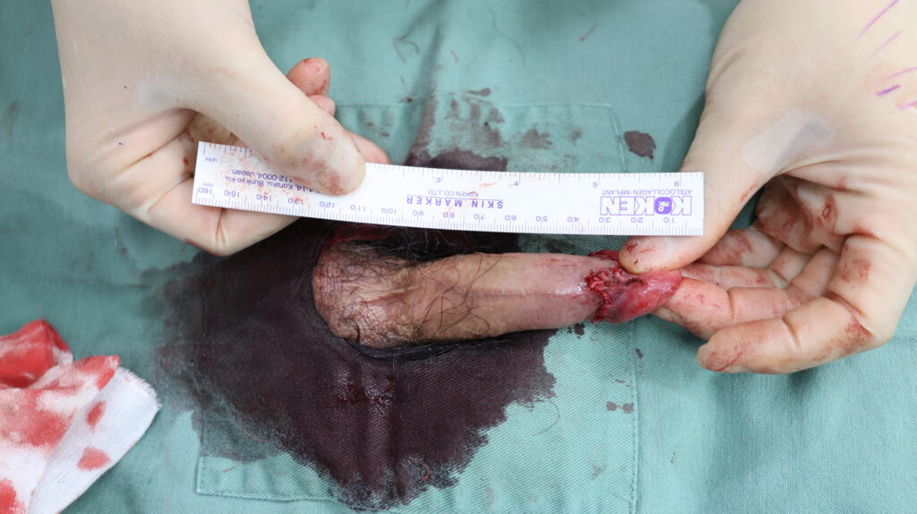 【症例23】40代男性 |アルモ式バック筋膜切開(靭帯剥離併用あり)+包茎術+小帯切開で16mm延長術後2