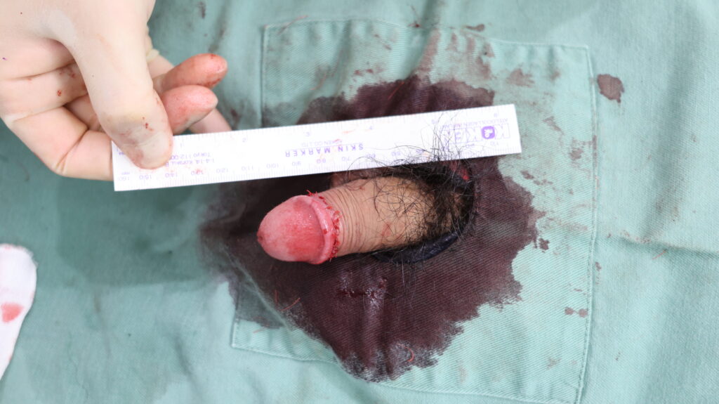 【症例23】40代男性 |アルモ式バック筋膜切開(靭帯剥離併用あり)+包茎術+小帯切開で16mm延長術後