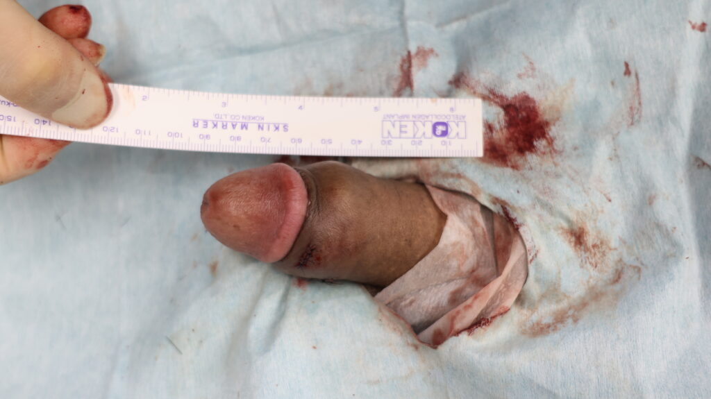 【症例19】40代男性 ｜アルモ式バック筋膜切開（靭帯剥離併用あり）で8ｍｍ増大術後3ヶ月3