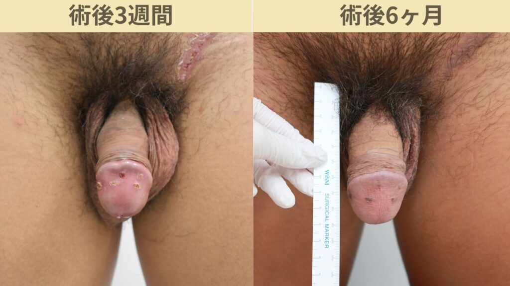 【症例20】30代男性 ｜アルモ式バック筋膜切開（靭帯剥離併用あり）＋包茎術で長茎19mm延長術後6ヶ月