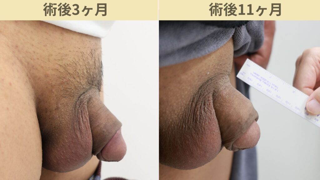 【症例19】40代男性 ｜アルモ式バック筋膜切開（靭帯剥離併用あり）で8ｍｍ増大術後11ヶ月