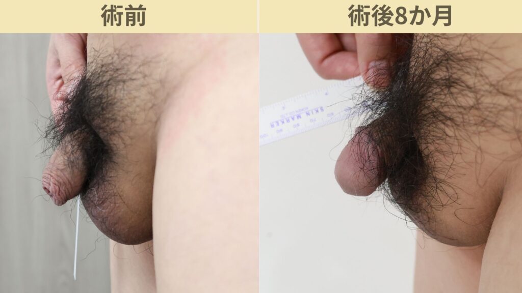 【症例23】40代男性 |アルモ式バック筋膜切開(靭帯剥離併用あり)+包茎術+小帯切開で16mm延長術後8ヶ月