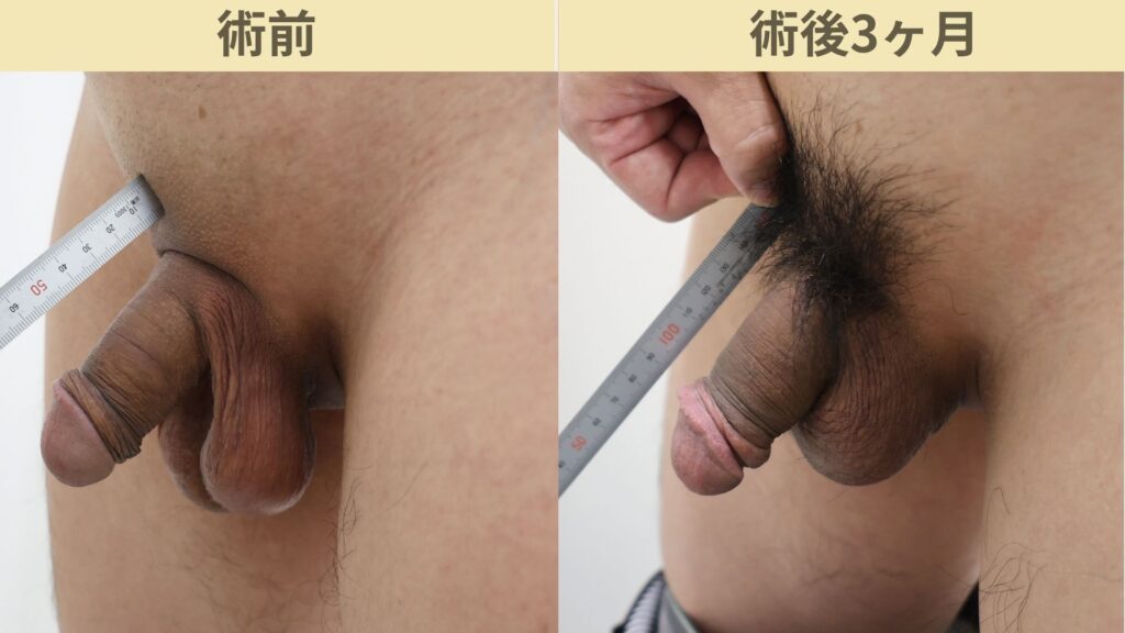 【症例70】40代男性 ｜アルモ式バック筋膜切開（靭帯剥離併用あり）＋包茎術で長茎21mm延長術後3ヶ月4