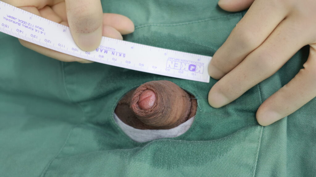 【症例30】30代男性 ｜アルモ式バック筋膜切開（靭帯剥離併用あり）＋包茎術で埋没陰茎改善へ術前2