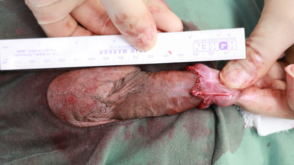 【症例30】30代男性 ｜アルモ式バック筋膜切開（靭帯剥離併用あり）＋包茎術で埋没陰茎改善へ術後2