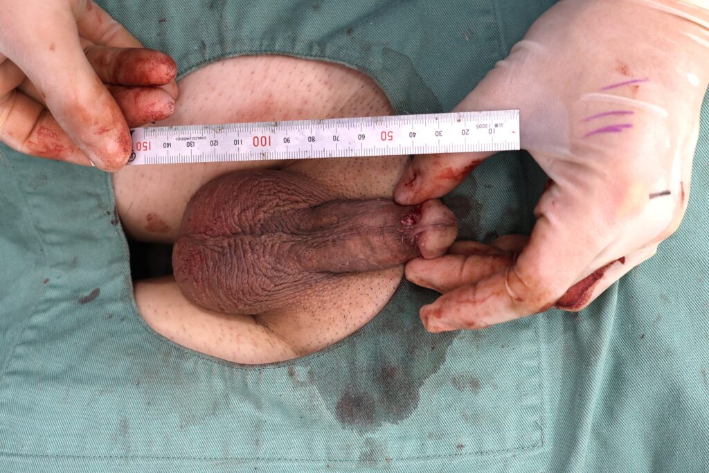 【症例87】40代男性 |アルモ式バック筋膜切開(靭帯剥離併用あり)+真皮脂肪移植も併用術後2