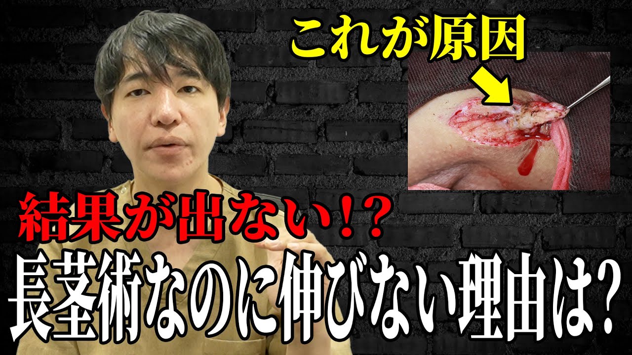 【後悔しない】長茎術で縮んでしまった患者の症例を紹介します！