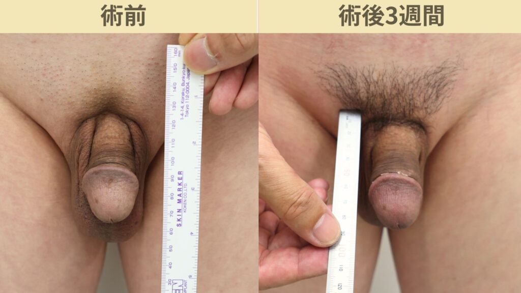 【症例69】50代男性 |アルモ式バック筋膜切開(靭帯剥離併用あり)+傷跡修正で長茎22mm延長術後3週間3