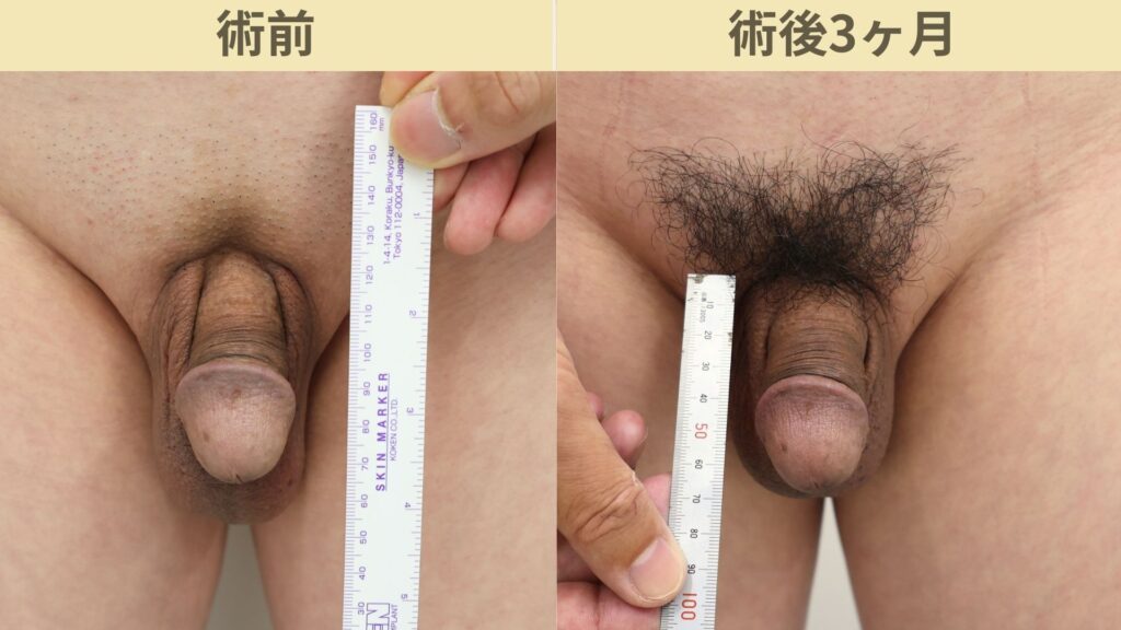 【症例69】50代男性 |アルモ式バック筋膜切開(靭帯剥離併用あり)+傷跡修正で長茎22mm延長術後3ヶ月3