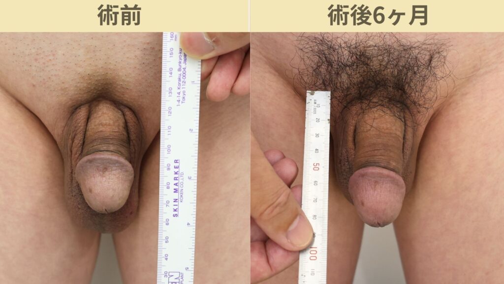 【症例86】50代男性 |亀頭ヒアルロン酸注入4ccで7mmの増大症例術後6ヶ月2