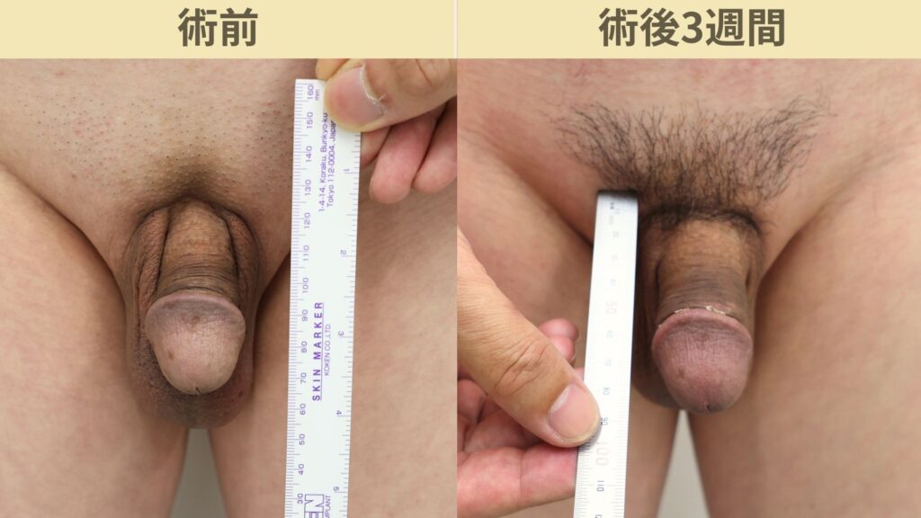 【症例86】50代男性 |亀頭ヒアルロン酸注入4ccで7mmの増大症例術後3週間2