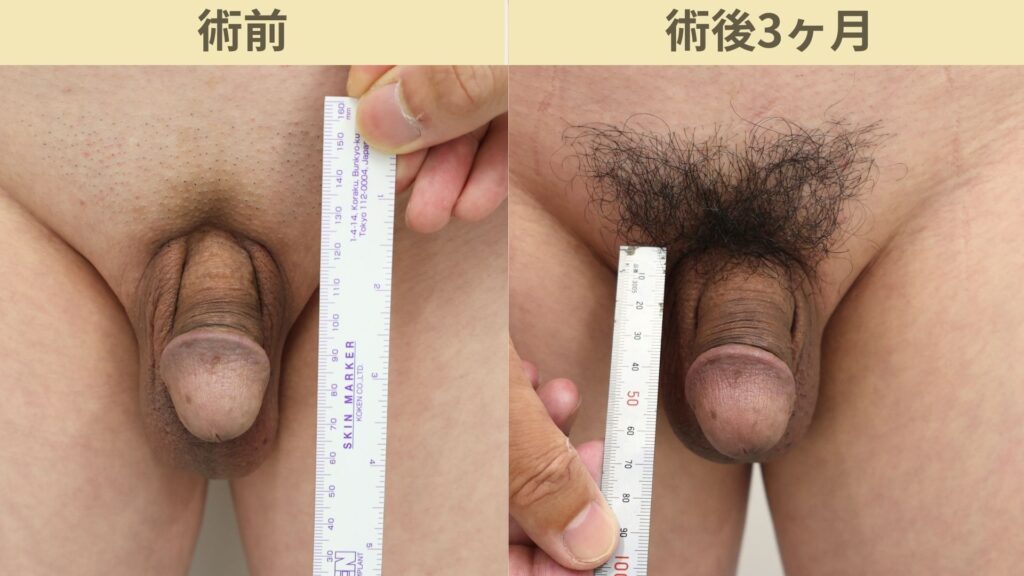【症例86】50代男性 |亀頭ヒアルロン酸注入4ccで7mmの増大症例術後3ヶ月2